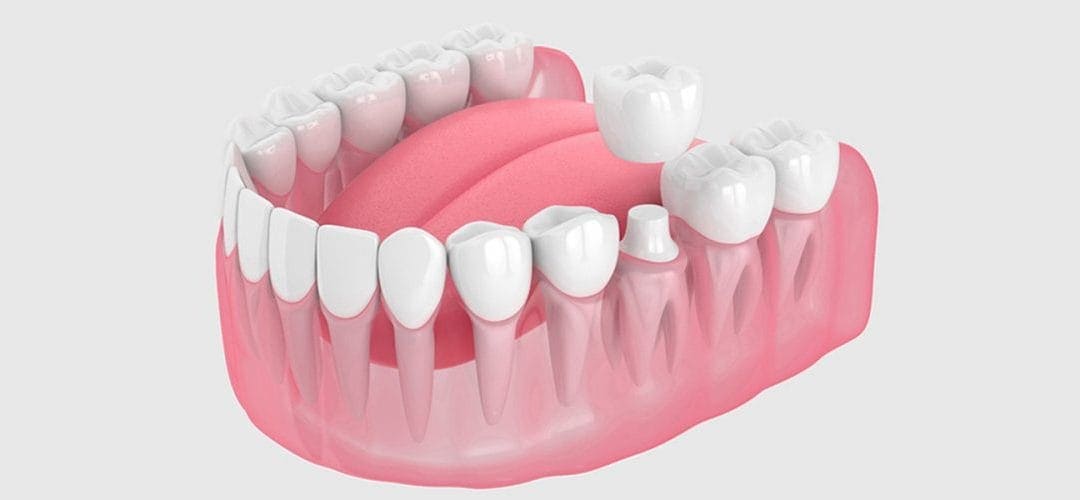 The Ultimate Guide to Dental Crowns: Your Smile’s Secret Superheroes!