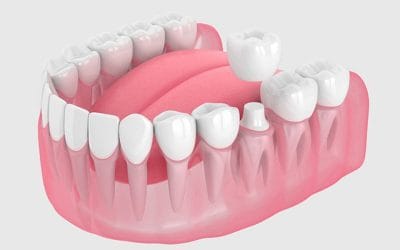 The Ultimate Guide to Dental Crowns: Your Smile’s Secret Superheroes!